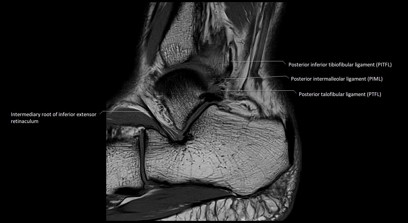 MRI ankle ligaments anatomy sagittal 3T image 21.webp